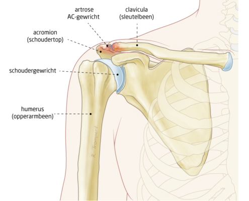AC-artrose - het FysioHuis