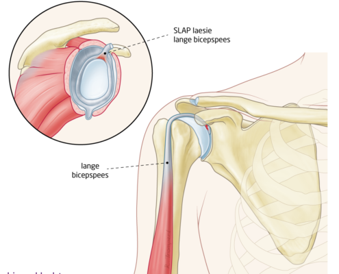 bicepsklachten - het FysioHuis