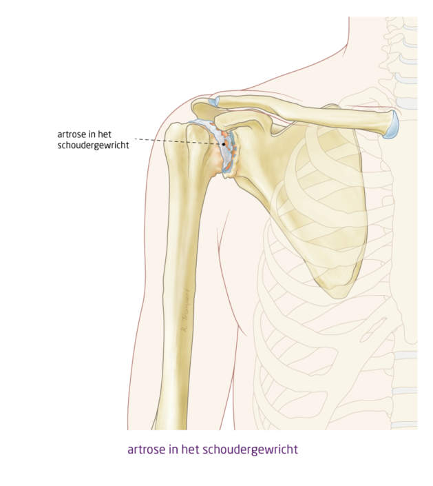 schouder-artrose-het-schouderhuis