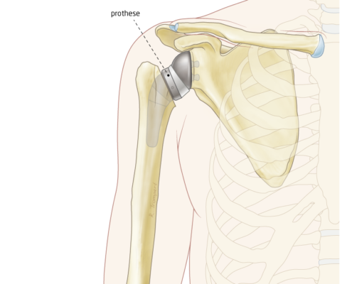 eversed-prothese-het-schouderhuis