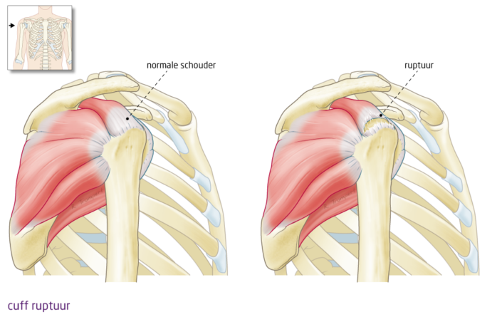 peesscheur schouder - het FysioHuis