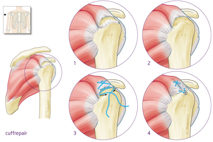 cuffrepair-het-fysiohuis
