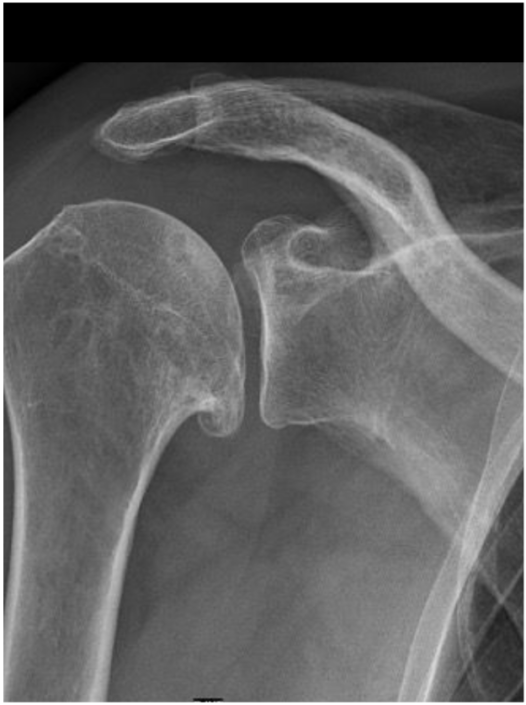 röntgenfoto-artrose-schouder-het-schouderhuis