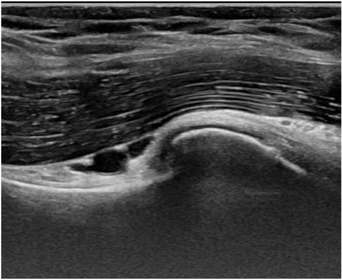 artrose-schouder-echo-het-schouderhuis