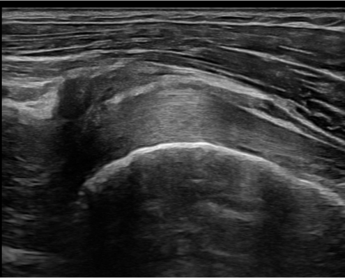 biceps-lengte-opname-echografie-het-fysiohuis
