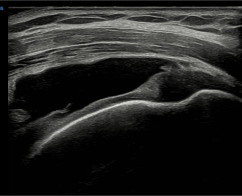 cuffruptuur-echografie-het-FysioHuis